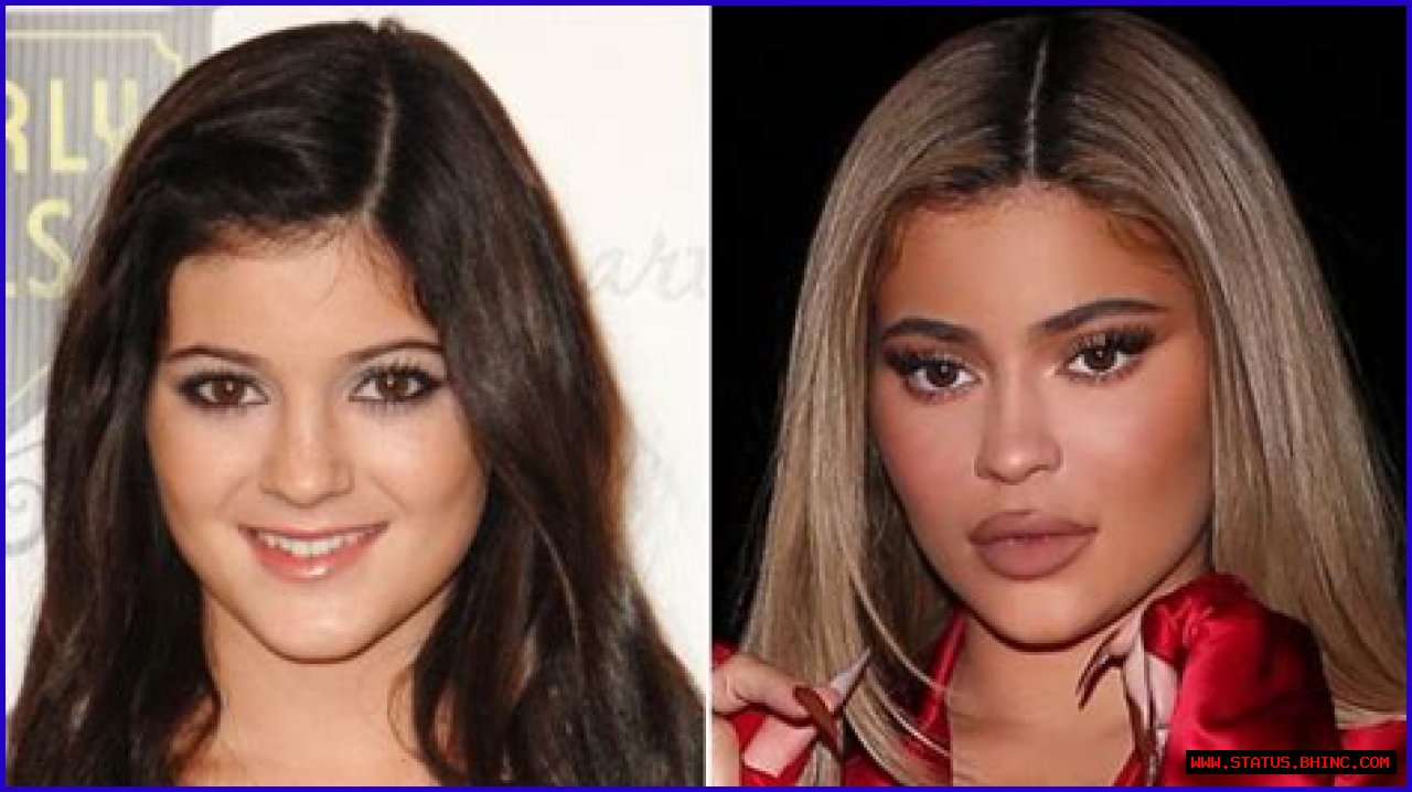 Kylie Jenner Is No Stranger to Plastic Surgery: Her Transformation Before and After Lip Fillers